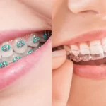 Invisalign: Harnessing Nanotechnology for Superior Smile Design