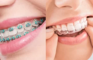 Invisalign: Harnessing Nanotechnology for Superior Smile Design